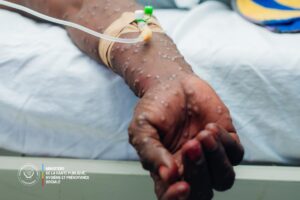 Lire la suite à propos de l’article RDC : plus de 1.450 cas de M-pox notifiés à la 14ème semaine épidémiologique